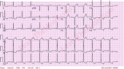 lv long wall|lvh with repolarization abnormalities.